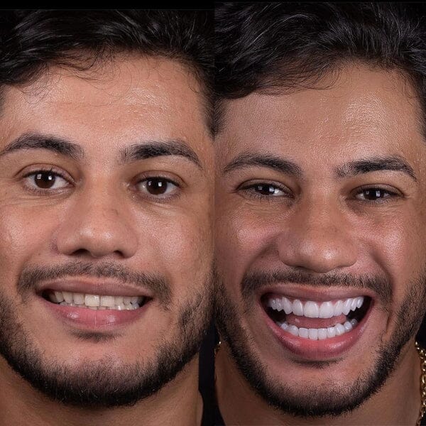 Facetas Odontológicas Removíveis